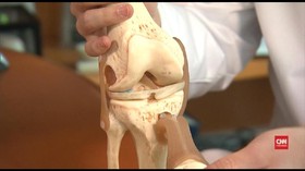 Perempuan Lebih Rentan Terkena Osteoporosis