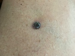 Ini 8 Ciri-ciri Kanker Kulit pada Tubuh, Apa Saja?