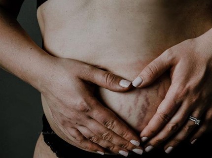 Foto: Garis dan Lipatan 'Cinta' di Perut Ibu
