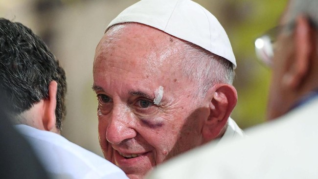 Paus Fransiskus mengalami 'kecelakaan' kecil karena hilang keseimbangan di popemobile dan menyebabkan tulang pipinya memar dan kelopak matanya bengkak.