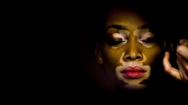 Vitiligo merupakan penyakit yang bisa membuat penderitanya depresi. Mengapa? Simak pembahasan lengkap soal vitiligo sebagai berikut.