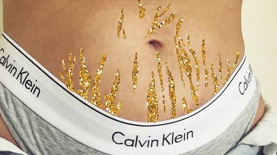 Jangan Sampai Stretch Mark Bikin Kita Minder Ya, Bun