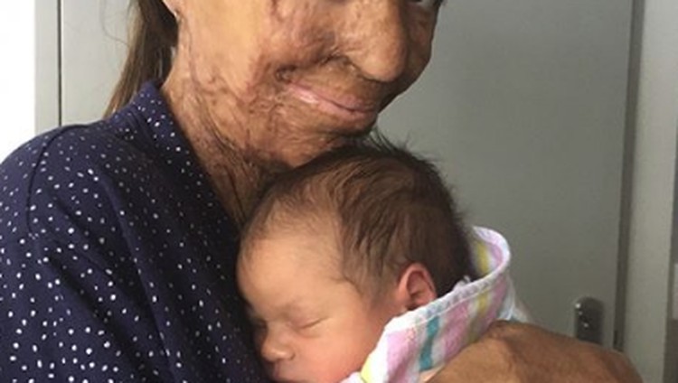 Berkat dirinya selalu berpikiran positif, Turia Pitt, korban luka bakar sekaligus motivator, sukses melahirkan bayi tanpa halangan.