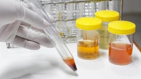 Awas! Gejala Kanker Ginjal Bisa Terlihat dari Urine