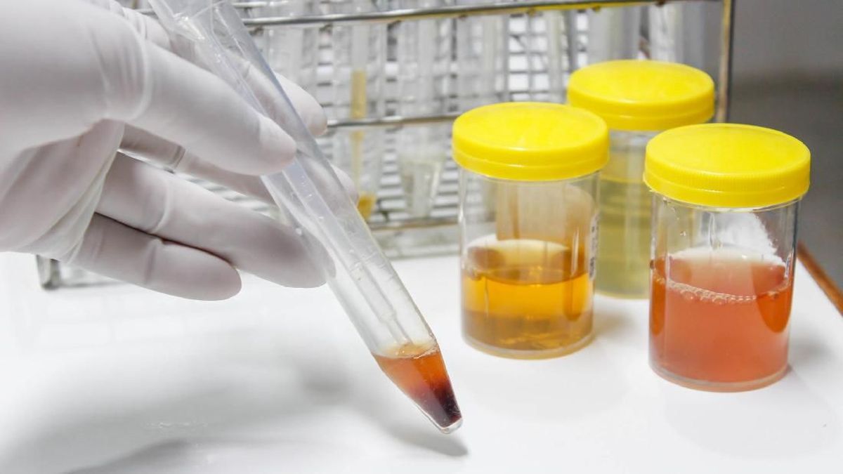 Awas! Gejala Kanker Ginjal Bisa Terlihat dari Urine