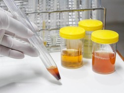 Warna Urine Ini Jadi Tanda Sakit Ginjal, Segera Periksa Jika Mengalaminya