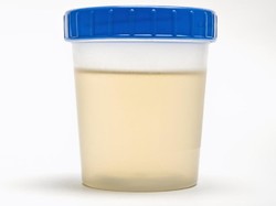 Ciri Warna Urine yang Sehat dan Penyebab Perubahan Warnanya