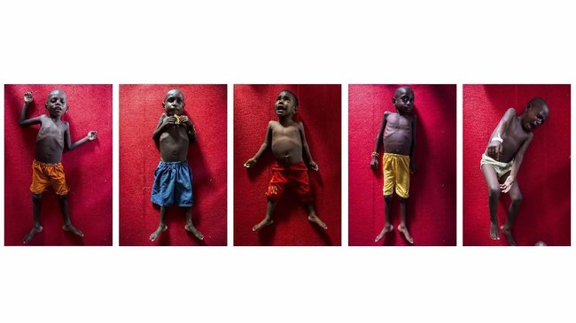 Kasus gizi buruk di Asmat bukan kasus baru. Sejak 2005 sudah ada kasus gizi buruk di Papua, pemerintah dinilai kurang sigap menanganinya.
