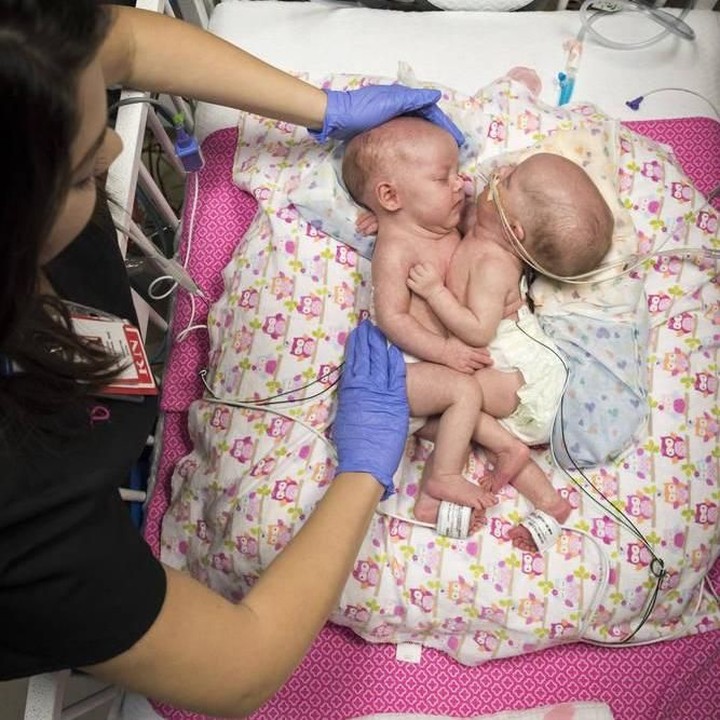 <p>Sebelum operasi pemisahan, butuh  perencanaan seperti penelitian ekstensif, pencitraan, dan pemodelan 3-D yang memakan waktu beberapa bulan. (Foto: Allen S. Kramer/Texas Children’s Hospital)</p>