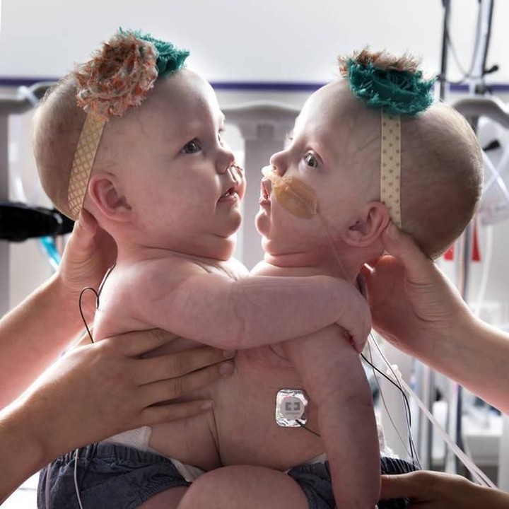 <p>Hampir setahun lamanya, sekelompok spesialis merawat si kembar, Anna dan Hope di NICU. Keluarga pun berharap mereka bisa segera dipisahkan. (Foto: Allen S. Kramer/Texas Children’s Hospital)</p>