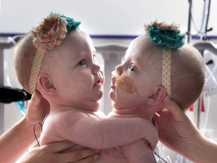 Momen Haru Saat Bayi Kembar Siam Sukses Jalani Operasi Pemisahan