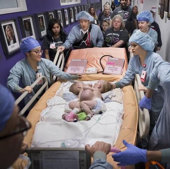 <p>Bulan Januari 2018, operasi pemisahan itu akhirnya dilakukan. (Foto: Allen S. Kramer/Texas Children’s Hospital)</p>