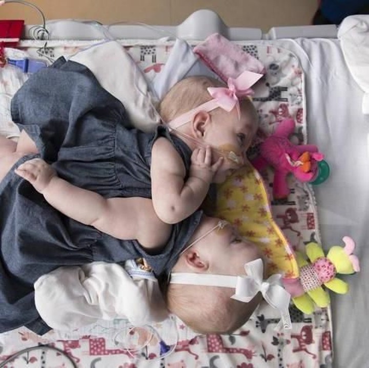 <p>Di bulan November 2017, dilakukan operasi pemasangan ekspander jaringan di dada Anna dan Hope untuk meregangkan kulit mereka agar bisa menutupi dada setelah operasi kedua. (Foto: Allen S. Kramer/Texas Children’s Hospital)</p>
