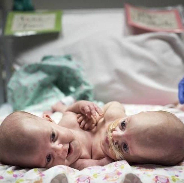 <p>Pada Desember tahun 2016 lalu, seorang ibu melahirkan bayi kembar siam. Kondisi badan dan pembuluh darah utamanya menyatu. (Foto: Allen S. Kramer/Texas Children’s Hospital)</p>