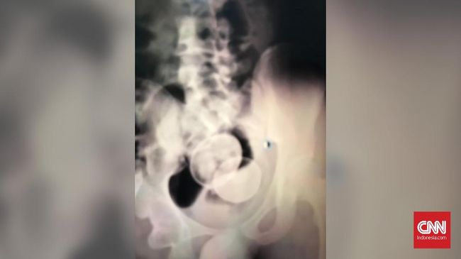 Diagnosis Dokter Pemeriksa Soal Remaja Bertelur di Gowa Berkaca catatan medis dan tindakan yang sudah dilakukan, dokter pemeriksa menduga ada unsur kesengajaan sehingga telur bisa berada dalam tubuh remaja asal Gowa.