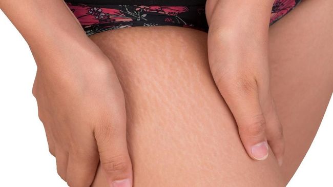 Selulit membuat banyak perempuan merasa tidak percaya diri. Namun, banyak cara alami untuk mengatasinya.