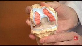 VIDEO: Kurangi Risiko Osteoporosis dengan Pola Makan Sehat