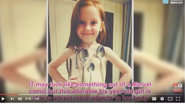 Dandy Walker Syndrome, Kondisi yang Juga Dialami Adam Fabumi