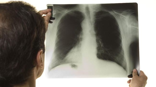 Selama lebih dari satu dekade, Binsar Malik asal Medan berjuang menghadapi sakit Tuberkulosis yang dideritanya. Kurangnya informasi mengenai TBC jadi hambatan.