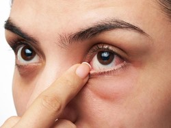 Fakta Soal Mata Bengkak Gara-gara Sering Main Handphone