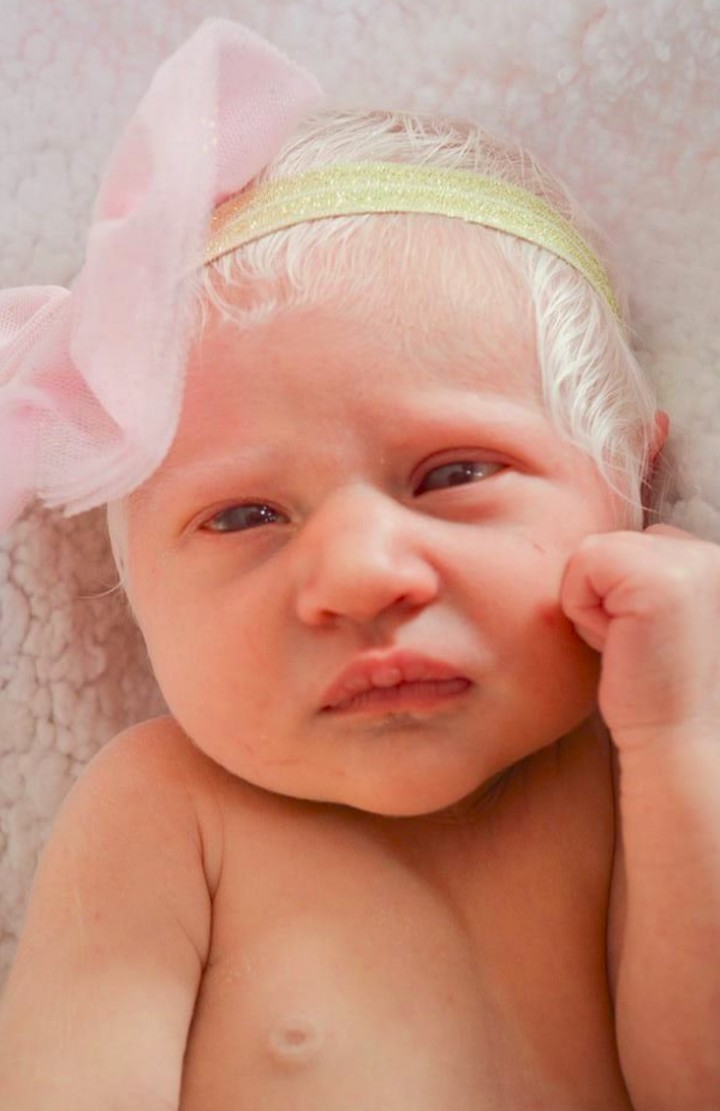 Lahir dengan kondisi albino dan rambutnya putih, bayi ini tetap imut dan menggemaskan.