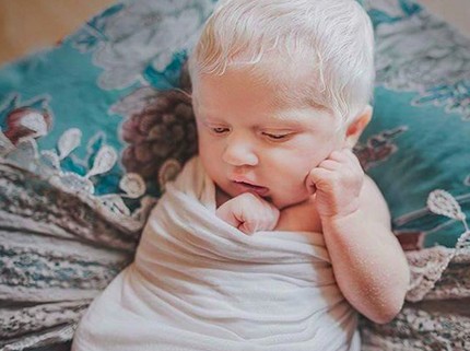 Nora, si Bayi Elsa 'Frozen' yang Berambut Putih karena Albino