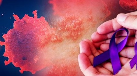 Lupus, Si Penyakit 1000 Wajah