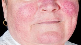 Faktor Hormonal Buat Lupus Lebih Berisiko pada Wanita