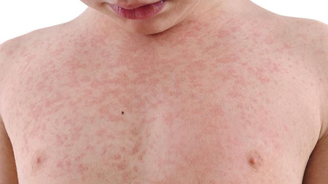 Lupus atau penyakit autoimun ini sebenarnya tidak bisa disembuhkan, tapi mengharuskan pengidapnya untuk terus mengonsumsi obat.