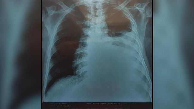 Sejumlah dokter ahli di Mayapada Hospital menyarankan setiap orang berisiko untuk melakukan deteksi dini demi mengurangi potensi penyakit kanker paru.