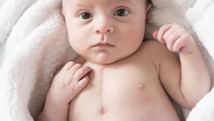 Bayi ini lahir dengan kondisi jantung setengah utuh. Tapi dia berhasil bertahan hidup, Bun.
