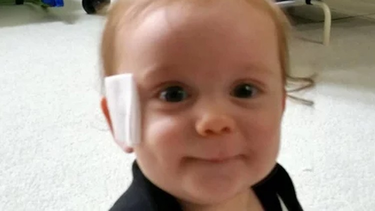 Cerita Bayi yang Wajahnya Terluka Gara-gara Empeng Balita ini alami luka di wajah akibat empeng. Kok bisa ya?