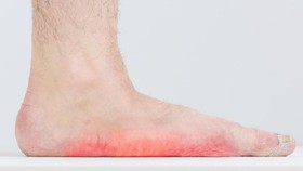 Kebiasaan yang Tak Disadari Jadi Pemicu 'Kaki Datar'
