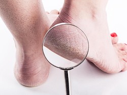6 Penyebab Tumit Kaki Pecah-pecah Serta Cara Mengobatinya