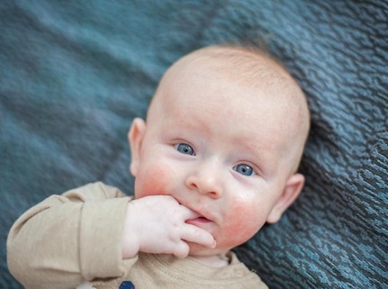 Kenali Dermatitis Atopik yang Bikin Kulit Bayi Gatal