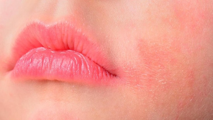 Bunda, kenali yuk, faktor pemicu terjadinya dermatitis atopik pada anak.