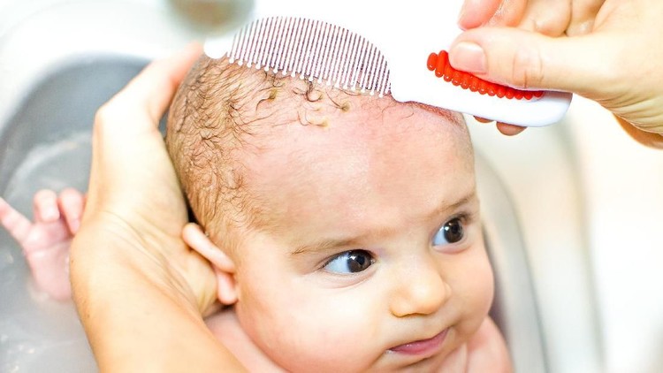 Pernah melihat kepala bayi berkerak seperti ada ketombenya, Bun? Kondisi itu dikenal sebagai cradle crap.