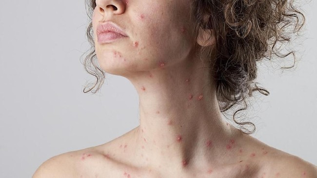 Cacar monyet diketahui disebabkan oleh virus monkeypox, yang berada dalam genus yang sama dengan virus variola, penyebab penyakit cacar.