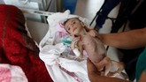 FOTO: Kisah Pilu Anak-anak Yaman Malnutrisi Korban Perang Perang yang menahun di Yaman membuat lebih dari 11 juta anak terancam kelaparan, kekurangan gizi, penyakit, dan kekurangan akses layanan kesehatan.