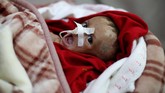 FOTO: Kisah Pilu Anak-anak Yaman Malnutrisi Korban Perang Perang yang menahun di Yaman membuat lebih dari 11 juta anak terancam kelaparan, kekurangan gizi, penyakit, dan kekurangan akses layanan kesehatan.
