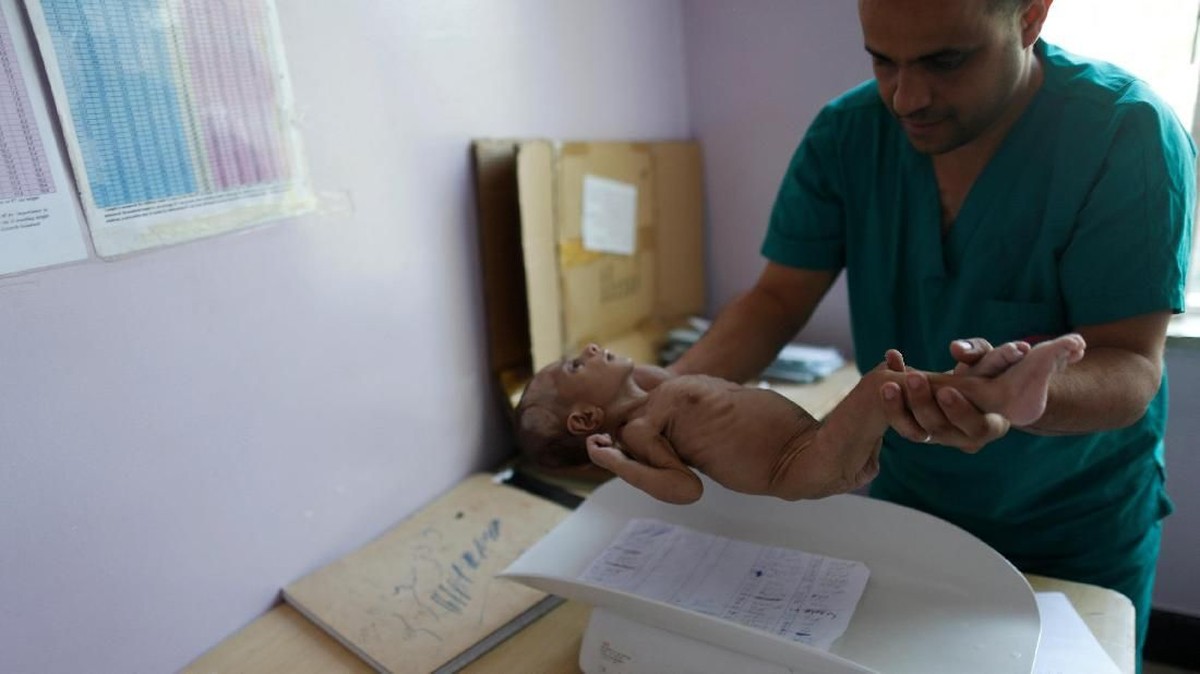 FOTO: Kisah Pilu Anak-anak Yaman Malnutrisi Korban Perang