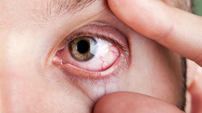 Orang dengan penyakit autoimun Sjogren's syndrome umumnya akan mengalami rasa perih pada mata dan kesulitan menelan.