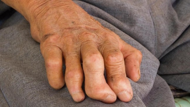 Kemenkes merespons dua kasus kusta WNI di Rumania dan menjadi yang pertama dalam 44 tahun di negara Uni Eropa.