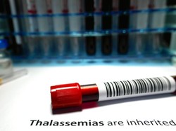 Gejala hingga Pencegahan Thalassemia, Penyakit Genetik yang Tak Bisa Sembuh