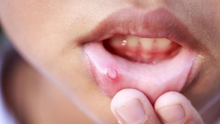 7 Obat Alami untuk Mengatasi Sariawan Si Kecil Kalau anak sariawan, Bunda nggak perlu cemas dan bingung cara mengobatinya. Bisa berikan obat alami ini ya.