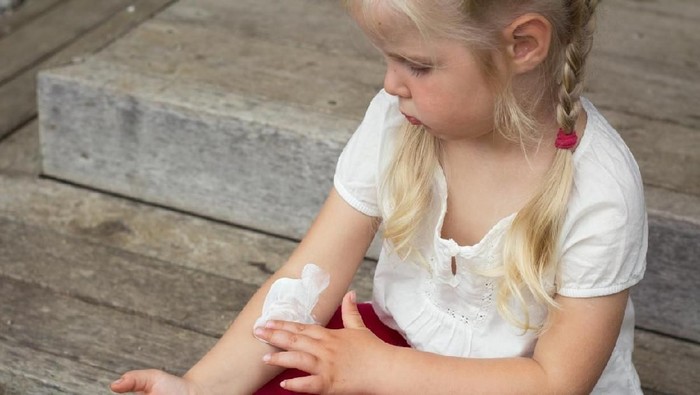 Girl applying dermatology cream on skin, eczema and skin allergy treatment.