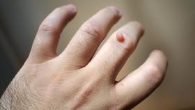 Cara Mudah dan Alami Hilangkan Kutil