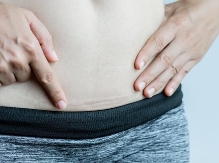 3 Hal yang Wajib Diketahui Saat Memilih Operasi Caesar untuk Melahirkan