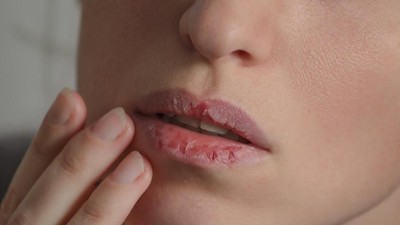 5 Kebiasaan Harian yang Memperburuk Bibir Pecah