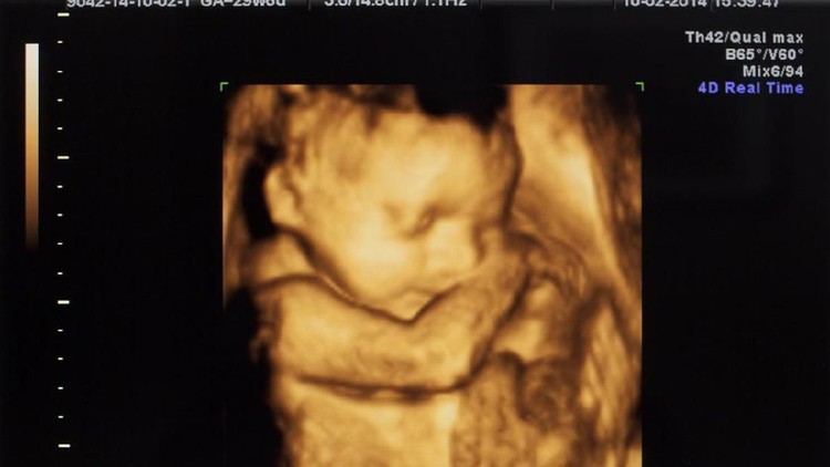 3D Ultrasound image